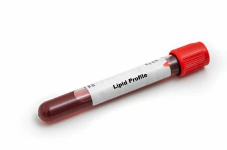 Lipid Profile-------18,RYAN Scan Diagnostic & Clinic, Dr. Praveena Goura