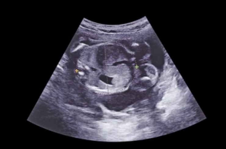 Obstetric _ Pregnancy Scans-------18,RYAN Scan Diagnostic & Clinic, Dr. Praveena Goura