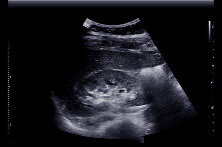 Abdomen and KUB Scan--------18